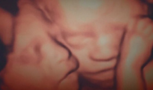 Minnesota Mothers One Dauther Dies After Separation Surgery Of The Conjoined Tween