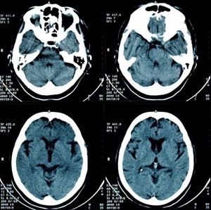 Arthritis Drug Effective In Treating Alzheimers Disease Too Study